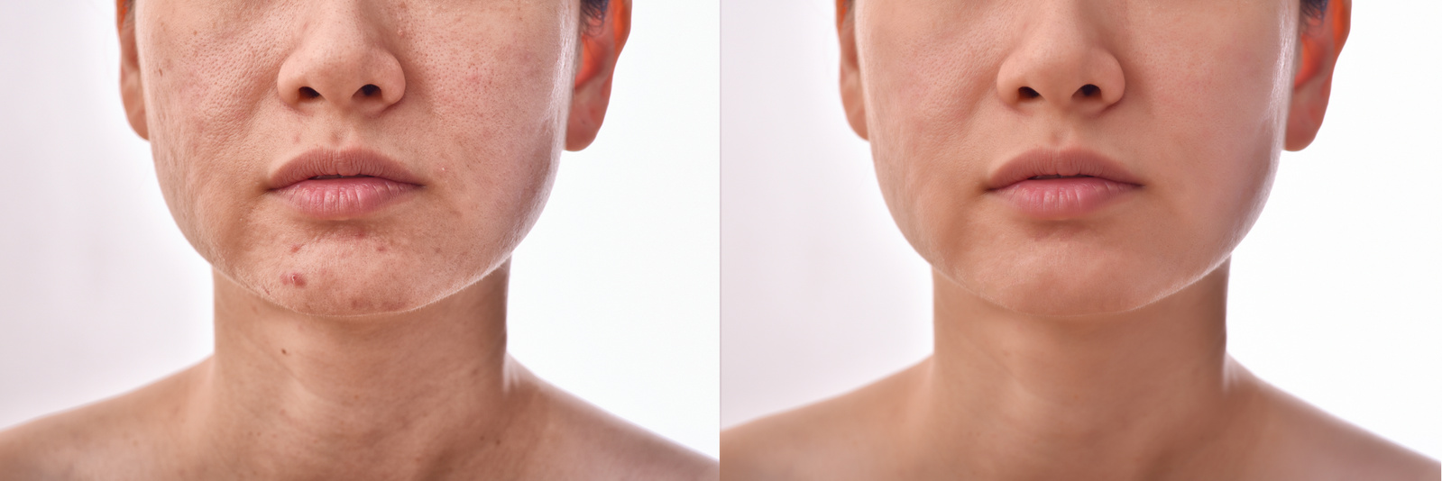 Face of Woman Before and After Acne Facial Care Treatment 